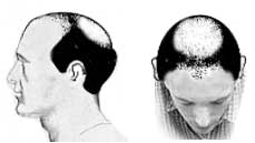 Hair Loss Stage VI Hair Loss Stage VI