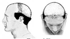 Hair Loss Stage VII Hair Loss Stage VII