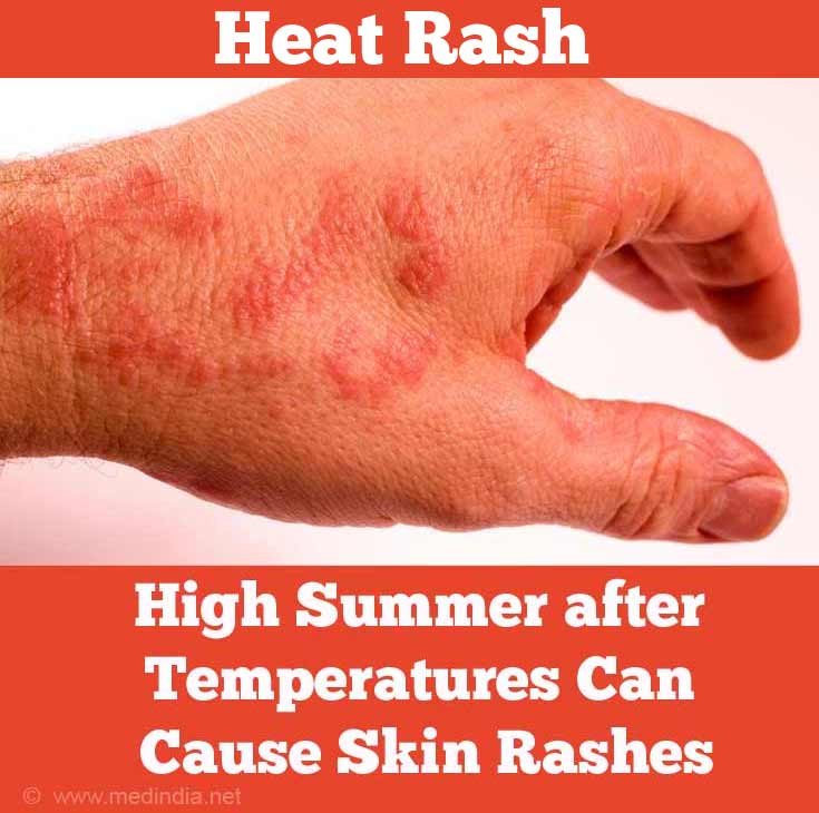 does heat rash itch more at night