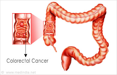 Blood in Stools: Colorectal cancer Blood in Stools: Colorectal cancer