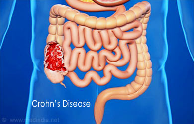 Blood in Stools: Crohn's disease Blood in Stools: Crohn's disease