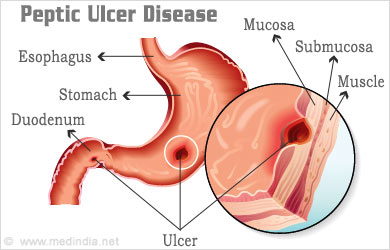 Blood in Stools: Peptic ulcer Blood in Stools: Peptic ulcer