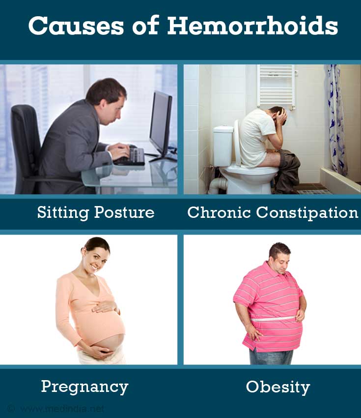 Hemorrhoids Piles Types, Causes, Symptoms, Diagnosis