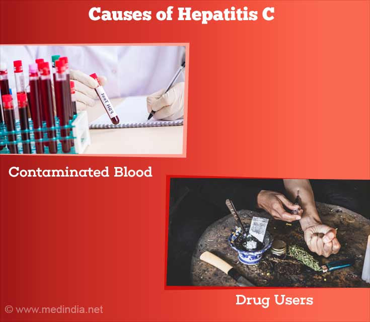 Causes of Hepatitis C Causes of Hepatitis C