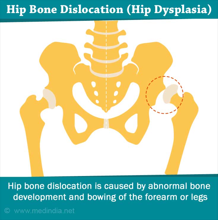 Exostoses / Multiple Non-cancerous Bone Tumors - Causes, Symptoms ...