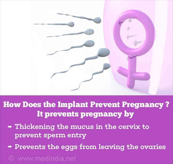 Birth Control Implant Benefits Disadvantages And Side Effects