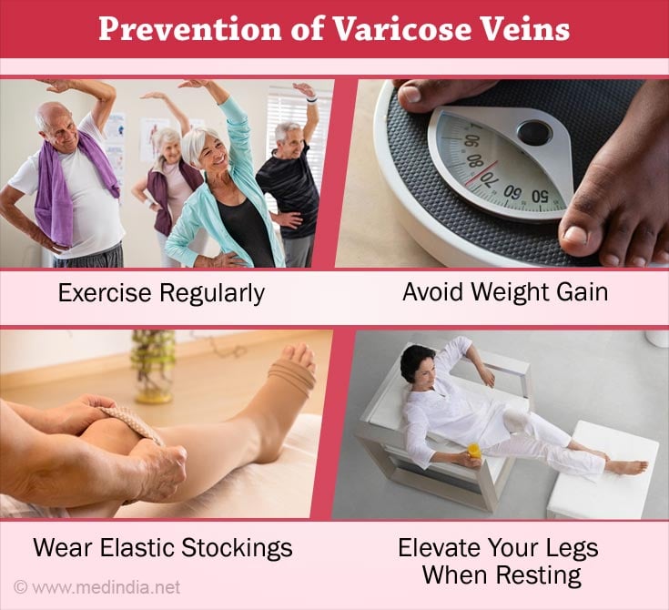 Prevention of Varicose Veins