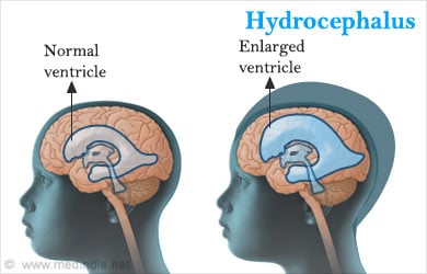 Hydrocephalus and Shunts, Fact Sheet, Health Information