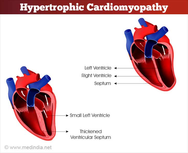 Hypertrophic Cardiomyopathy Causes, Symptoms, Diagnosis