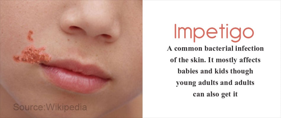 Impetigo - Symptoms, Causes, Complications, Diagnosis, Treatment