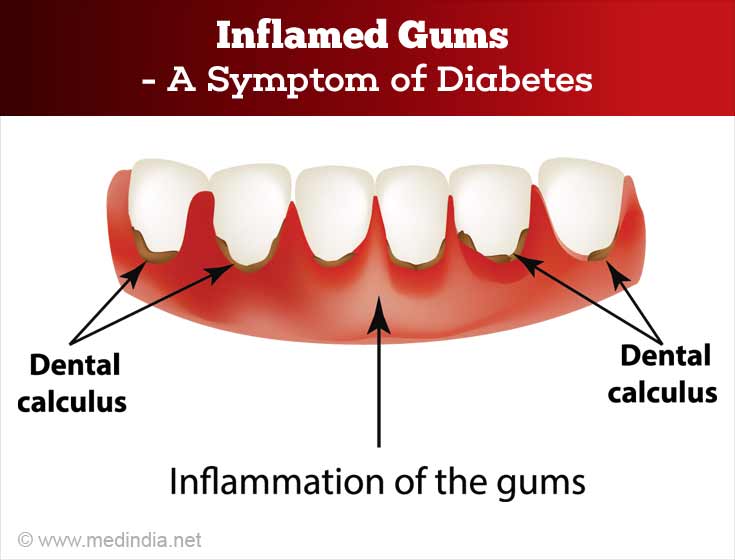 Inflames Gums For Diabetes Inflames Gums For Diabetes
