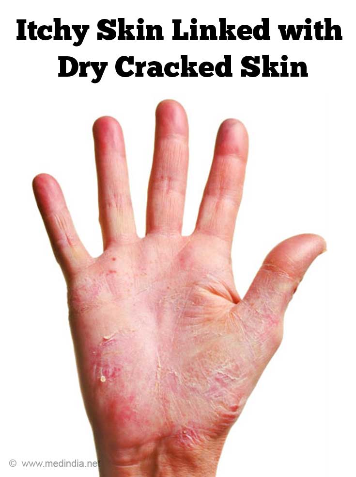 Itchy Skin Linked with Dry Cracked Skin Itchy Skin Linked with Dry Cracked Skin
