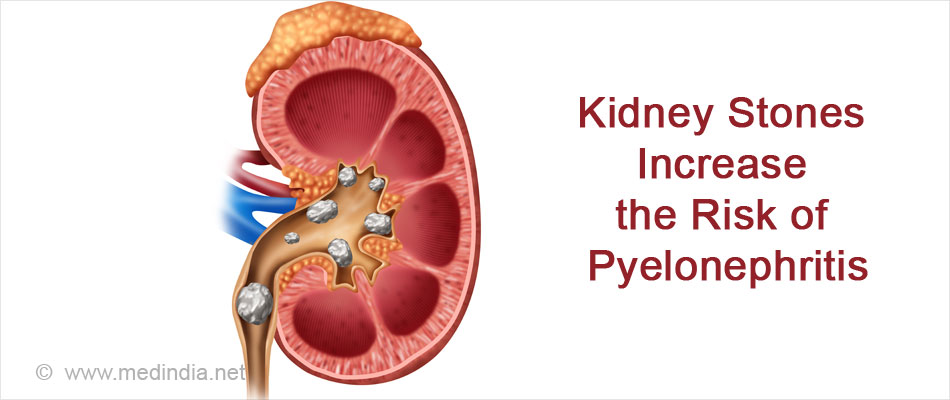 Kidney Infection (Pyelonephritis): Symptoms & Treatment