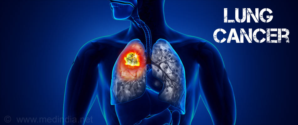 Lung Cancer - Types, Causes, Symptoms, Diagnosis, Treatment And Prevention