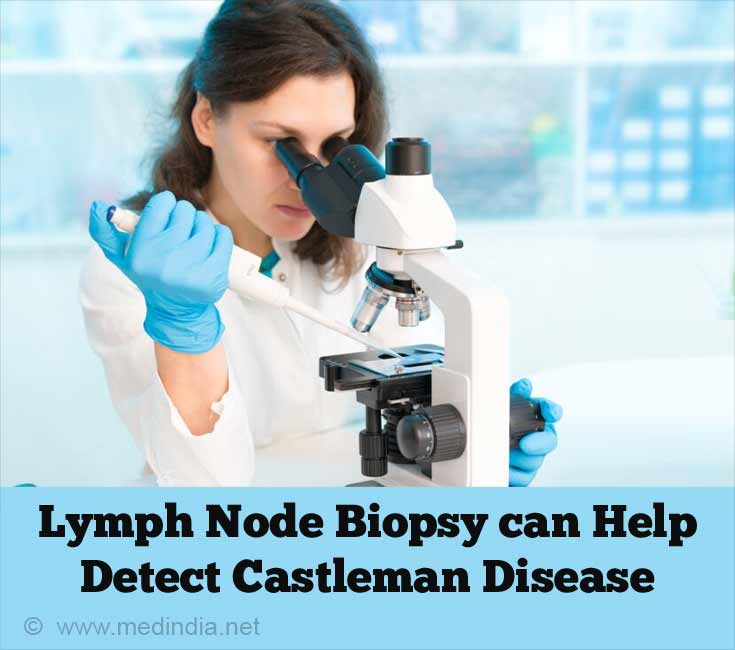 Lymph Node Biopsy can Help to differentiate Castleman Disease Lymph Node Biopsy can Help to differentiate Castleman Disease