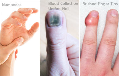 Mallet Finger Symptoms Mallet Finger Symptoms
