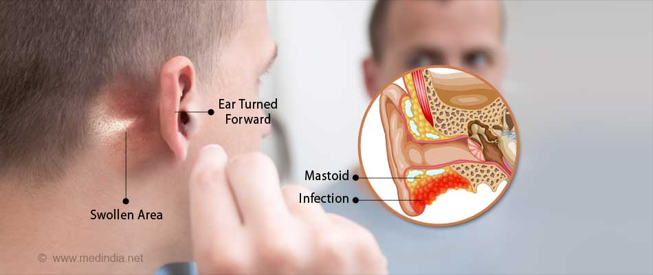 Mastoiditis Causes Symptoms Diagnosis Complications And Treatment 3820