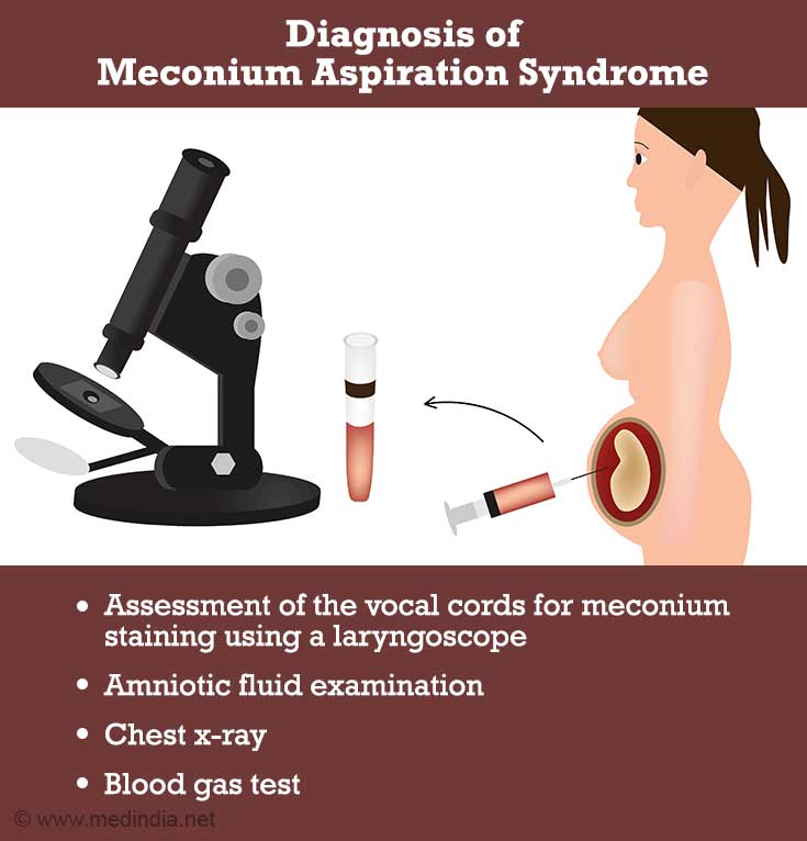 Diagnosis of Meconium Aspiration Syndrome Diagnosis of Meconium Aspiration Syndrome
