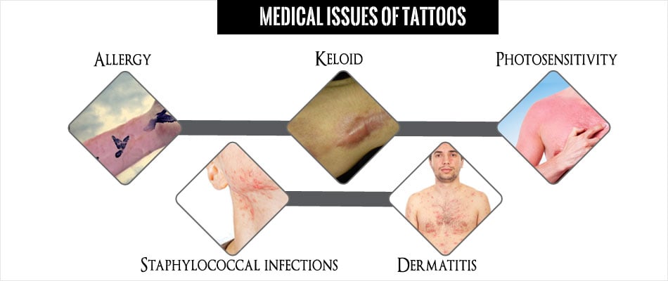 Tattoos Can Cause Serious Adverse Reactions  Live Science