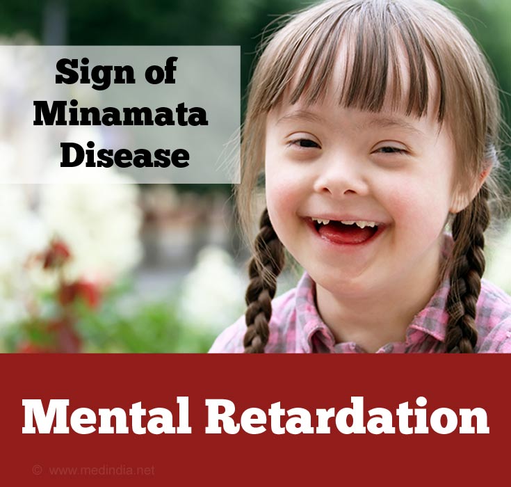 Mental Retardation Mental Retardation