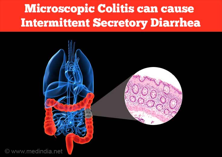 Microscopic Colitis Microscopic Colitis