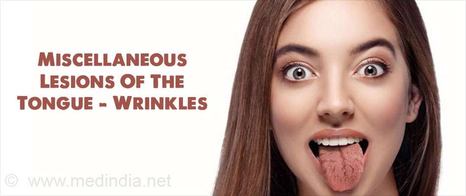 Miscellaneous Lesions of The Tongue - Wrinkles Miscellaneous Lesions of The Tongue - Wrinkles
