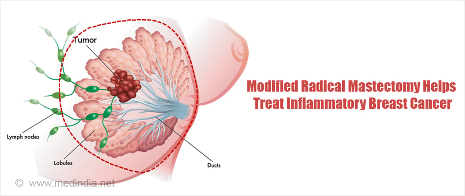 Inflammatory Breast Cancer - Causes, Symptoms, Diagnosis