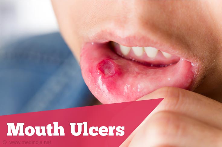 Mouth Ulcers Mouth Ulcers
