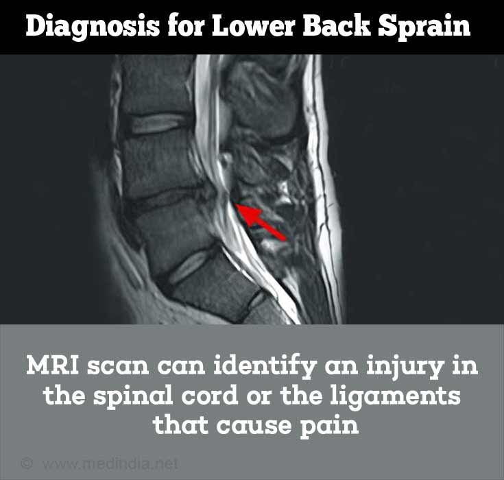 Back Sprain / Strain: Causes, Symptoms, Diagnosis, Treatment, Prevention