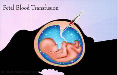 Multiple Fetal Blood Transfusions Multiple Fetal Blood Transfusions