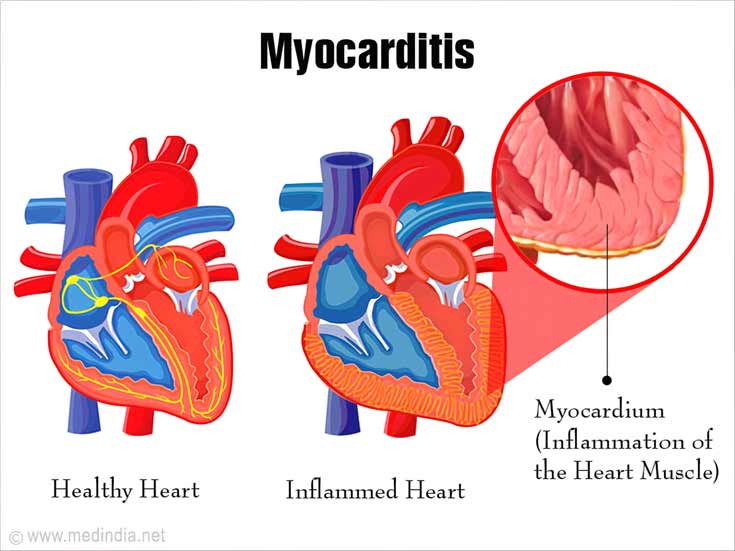 Myocarditis - Types, Causes, Symptoms, Complications, Treatment, Prognosis