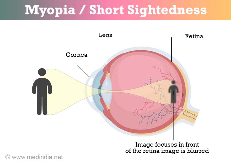 myopia-symptoms-and-diagnosis-treatment-faqs