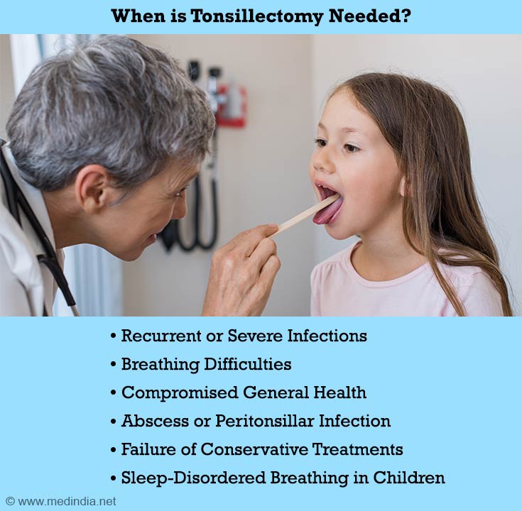 is-tonsillectomy-a-safe-procedure