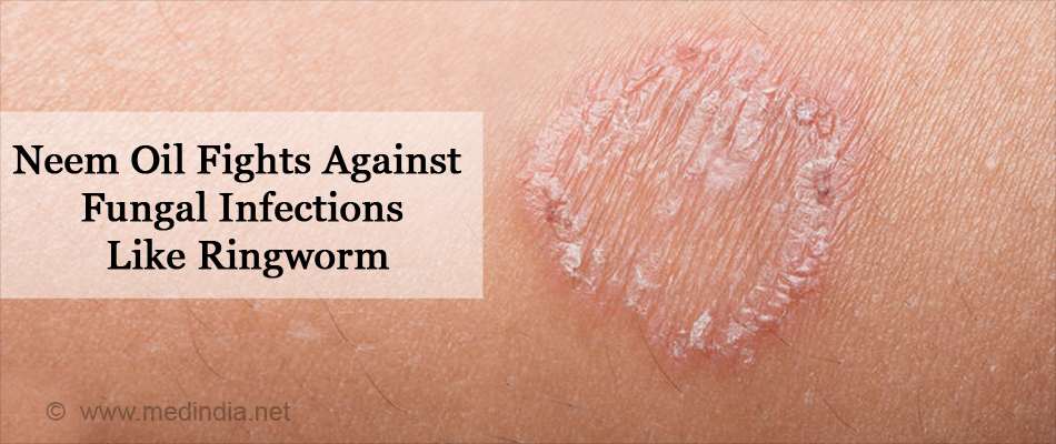 Neem Oil Fights Against Fungal Infections Like Ringworm Neem Oil Fights Against Fungal Infections Like Ringworm