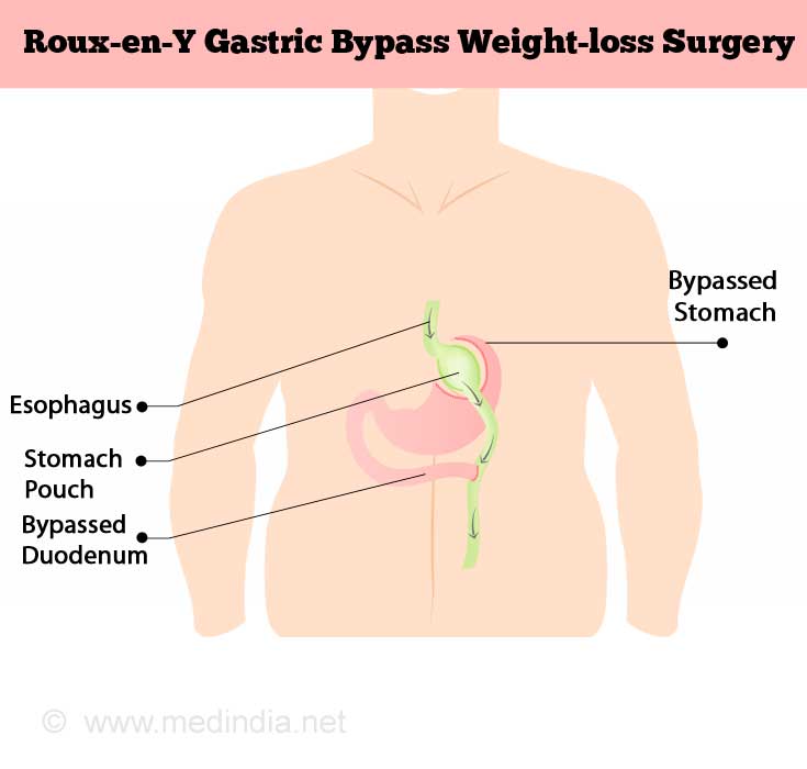 Roux-en-Y Gastric Bypass Weight-loss Surgery Roux-en-Y Gastric Bypass Weight-loss Surgery