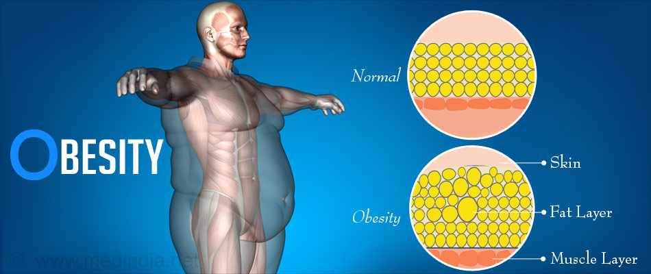 Obesity - Excess Body Fat Obesity - Excess Body Fat