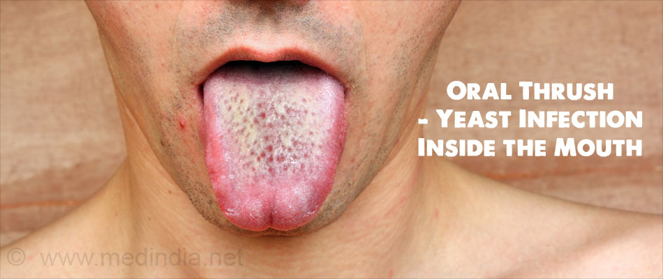Oral Thrush - Yeast Infection Inside the Mouth Oral Thrush - Yeast Infection Inside the Mouth