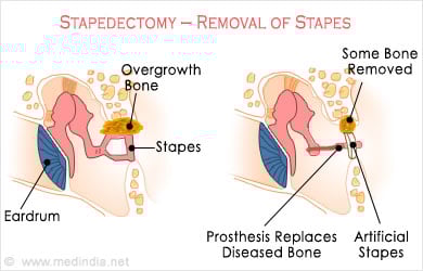 Otosclerosis Stapedectomy Otosclerosis Stapedectomy