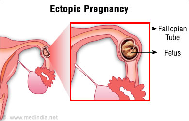 Ovarian Pain Ectopic Pregnancy Ovarian Pain Ectopic Pregnancy