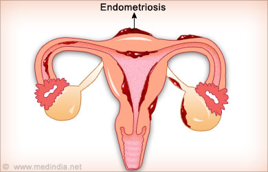 Ovarian Pain Endometriosis Ovarian Pain Endometriosis