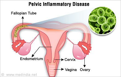 Ovarian Pain Pelvic Inflammatory Disease Ovarian Pain Pelvic Inflammatory Disease