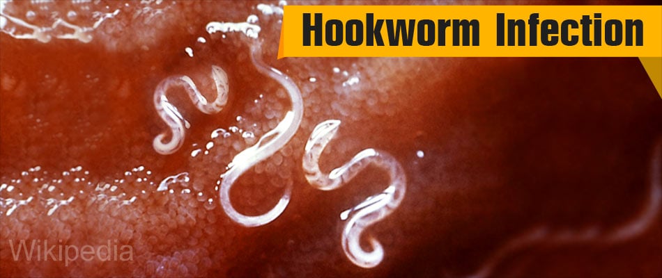 how common is hookworms in humans in the usa