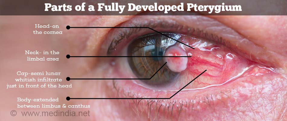 Pterygium - Stages, Types, Causes, Symptoms, Diagnosis, Treatment ...