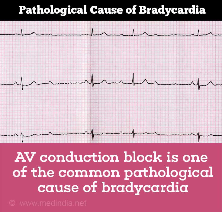 bradycardia-causes-symptoms-diagnosis-management