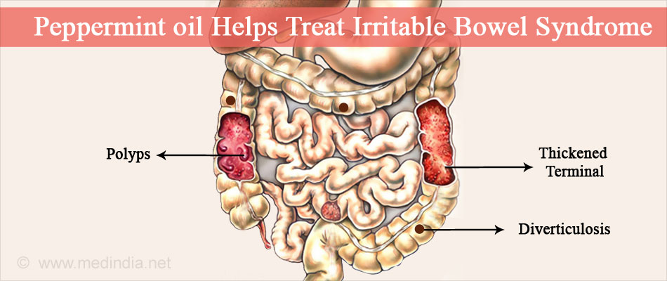 Peppermint Oil Helps Treat Irritable Bowel Syndrome Peppermint Oil Helps Treat Irritable Bowel Syndrome