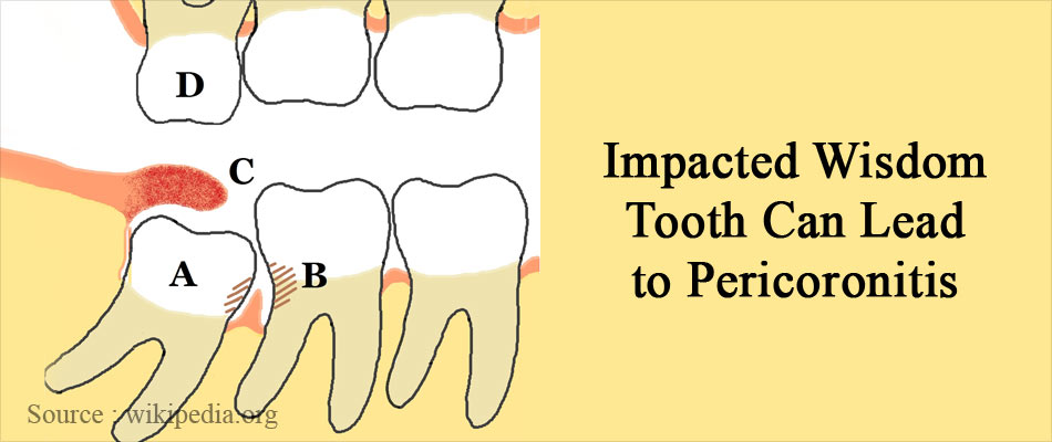 Complication of Impacted Wisdom Tooth - Pericoronitis Complication of Impacted Wisdom Tooth - Pericoronitis