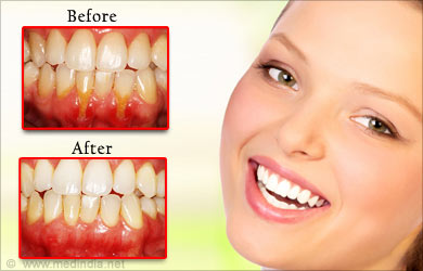 Periodontitis Soft Tissue Grafts Periodontitis Soft Tissue Grafts