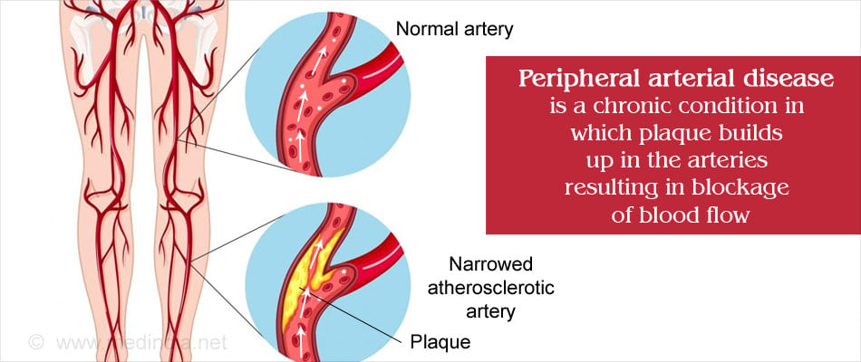 peripheral-artery-disease-pad-causes-symptoms-diagnosis