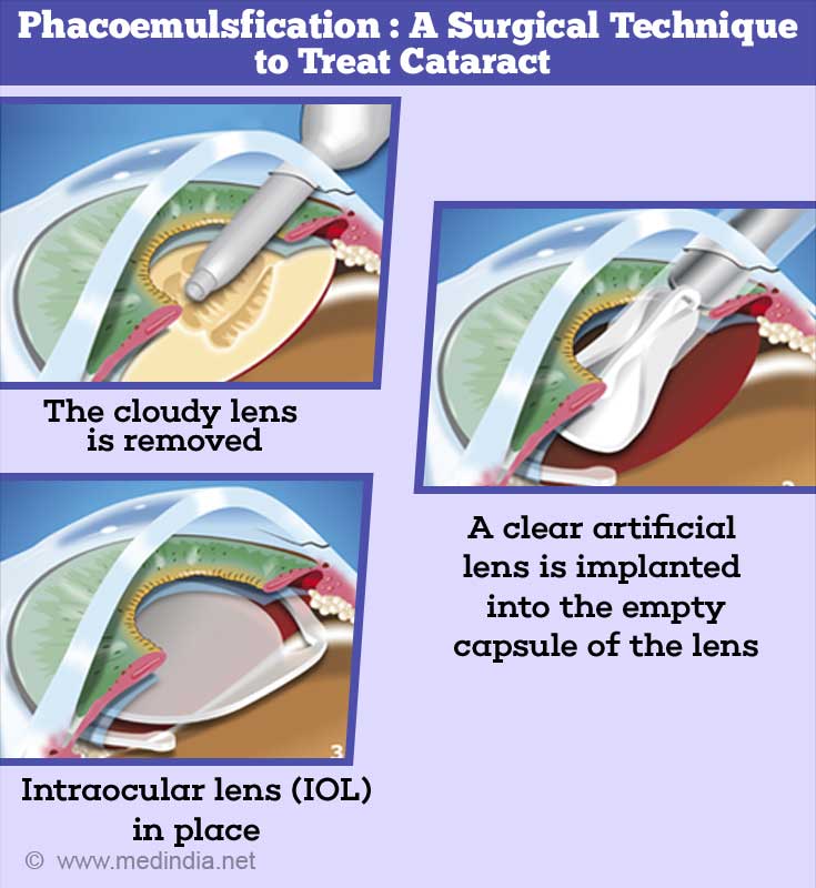 Cataract Causes, Symptoms, Diagnosis, Treatment & Prevention