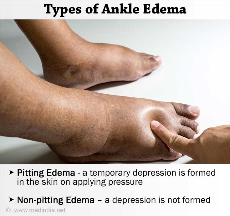 Foot Ankle And Leg Swelling Causes at Anna Cain blog